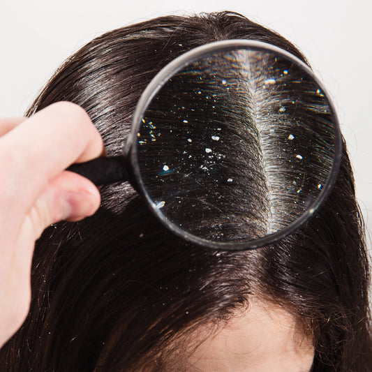 Dandruff